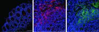 Images of cancerous and non-cancerous colorectal tissue, all infected with the oral bacteria F. nucleatum.